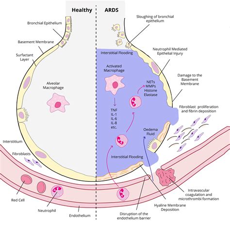 This inflammation causes fluid to leak into the lungs, which makes it extremely difficult to breathe and decreases the amount of oxygen going into the bloodstream. ARDS: Overview, Pathology & Diagnosis | theguidewire