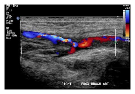 Ultrasound Scan Of The Right Proximal Brachial Artery Demonstrating A