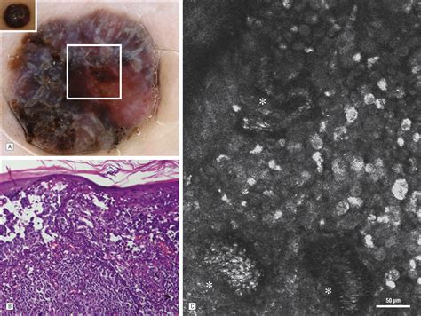 Pathology Outlines Nodular Melanoma
