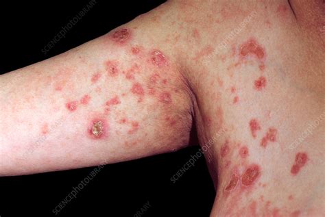 Pemphigus Foliaceus Stock Image C0348791 Science Photo Library