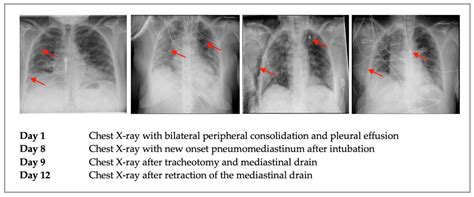 Covid Free Full Text Survival By Mediastinal Chest Drain Due To Pneumomediastinum Resulting