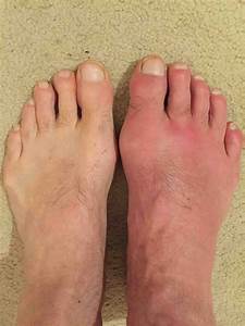 images of gout - pictures, photos Gout  