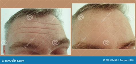 Male Forehead Wrinkles Before After Treatment Stock Photo Image Of