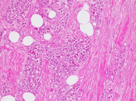 Breast Metastasis From An Olfactory Esthesioneuroblastoma A Case
