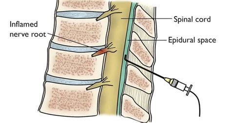 Cervical Epidural Steroid Injection Life After And What To Know