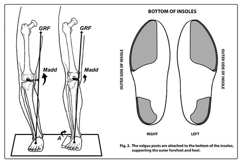 Peel And Stick Posts Forefoot And Rearfoot Valgus Posts Human Locomotion