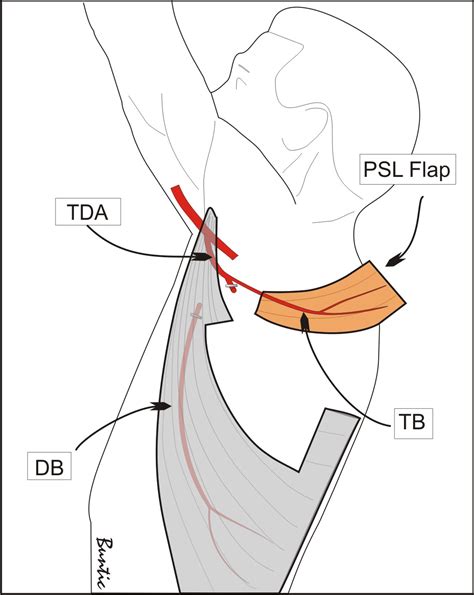 Latissimus Dorsi Flap For Breast Reconstruction Latis