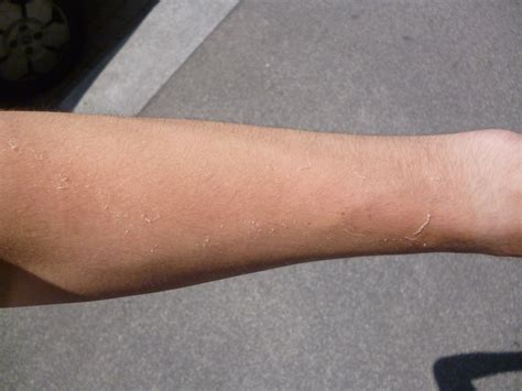 Filemildly Sunburnt Arm Wikimedia Commons