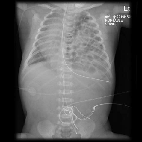 Congenital Diaphragmatic Hernia Chest X Ray Wikidoc