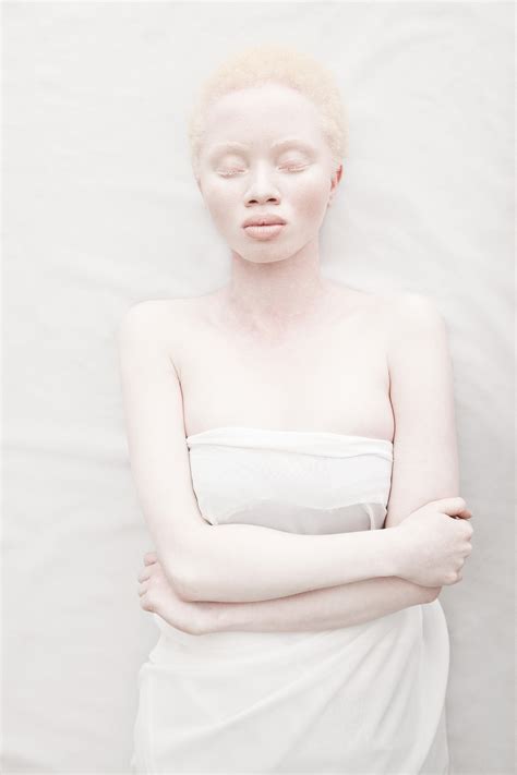 Striking Photos Of African Albinism Moss And Fog