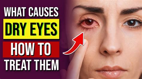 Dry Eyes Symptoms And Natural Remedies Youtube