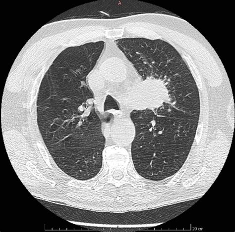 Figure 3 From Tumor Of The Nose A Rare Manifestation Of A Metastatic