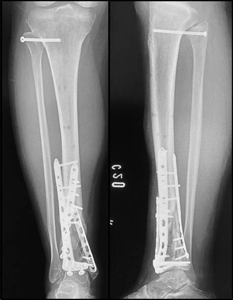 A Pilon Fracture With Fibular Head Dislocation Treated With The Use Of