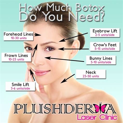 Botox Injection Sites For Migraines Diagram Board Nyrania2eu Botox