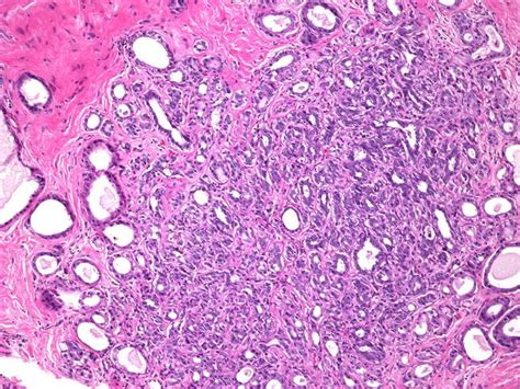 Sclerosing Adenosis 15 2x Risk Of Ca Histology Slides Medical