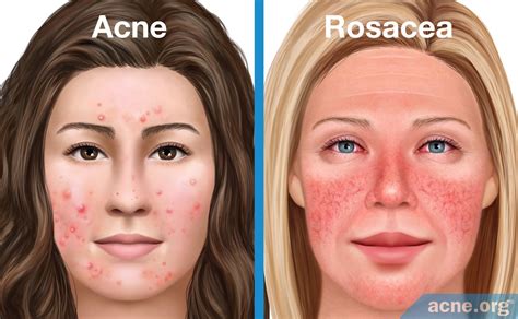 What Is Acne Page 5