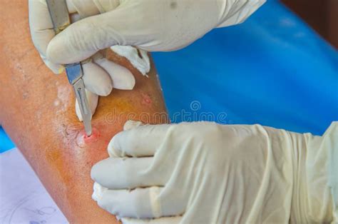 Incision And Drainage Deep Neck Infection At Hospital Stock Photo