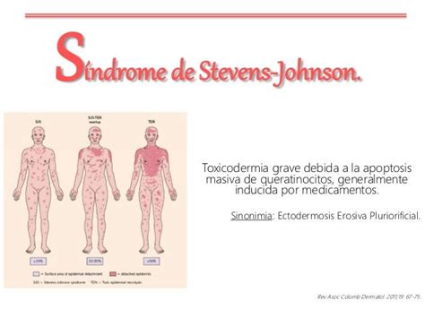 Síndrome De Stevens Johnson