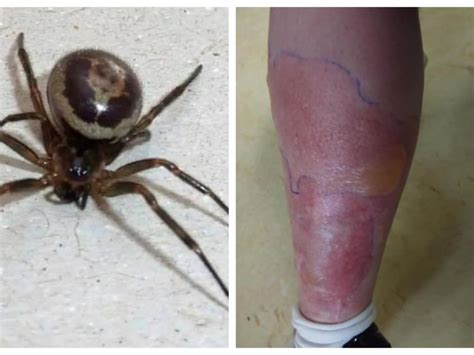 Woman Hospitalised For A Week After False Widow Spider Bite Leinster Leader