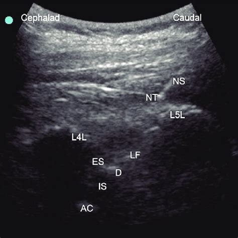 Us Image Showing Spinal Needle Insertion Real Time In The Paramedian