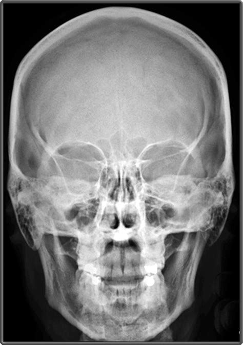 Clinical Anatomy Radiology Skull Bones