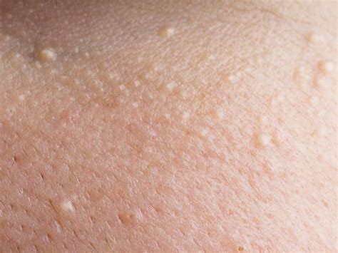 Small White Itchy Bumps On Skin Images And Photos Finder