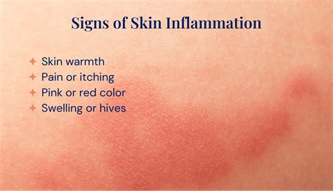 Skin Inflammation Causes Symptoms Diagnosis And Treat