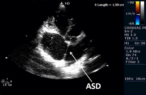 Transesophageal Echocardiography Confirmed The Diagnosis Of Ostium