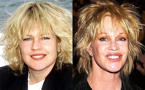 Celebrity Facelifts Gone Bad Before And After Pictures