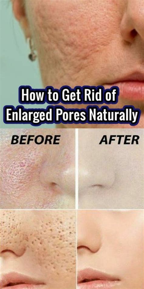 Best Way To Get Rid Of Large Pores Instantly Enlarged Pores Skin