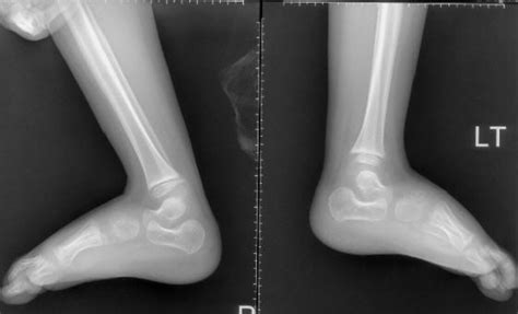 Severe Skew Foot Deformity In A Patient With Freeman Sheldon Syndrome