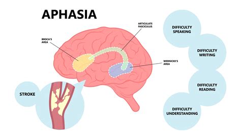 Aphasia What It Is How It Happens And How To Help Those Suffering