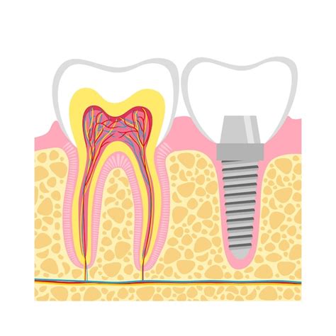 Ilustración De Vector De Implante Dental Y Dientes Humanos Vector Premium