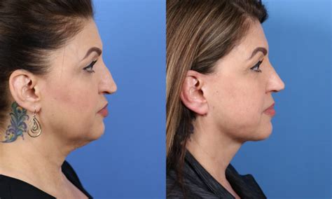 Beautiful Facelift Results In San Diego Ca By Dr John Hilinski