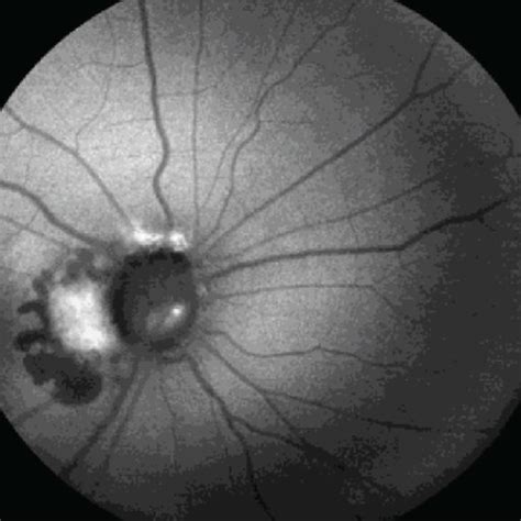 Optic Disc Swelling And Blurred Disc Margins In The Right A And Left