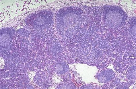 Grapora Follicular B Cell Lymphoma