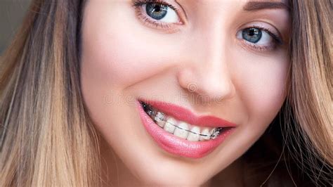 Beautiful Female Smile With Self Ligating Braces Orthodontic Tr Stock Image Image Of Female
