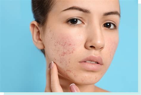 Get Face Acne Scars Types Images