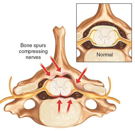 Posterior Cervical Fusion Procedure Globus Medical