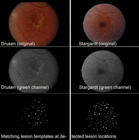 Examples Of Representative Fundus Images With Drusen Left And Flecks