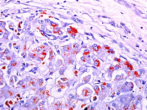 Pathology Outlines Wilson Disease