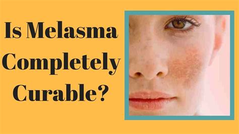 Melasma Skin Condition Treatment Best Anti Aging