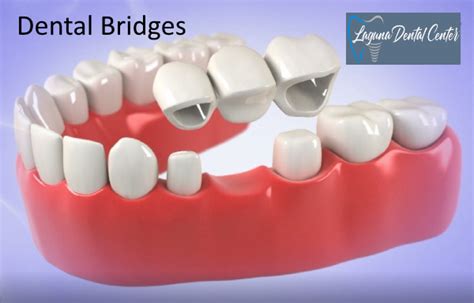 What Is A Bridge Dental Procedure Find Out The Advantages And Cost
