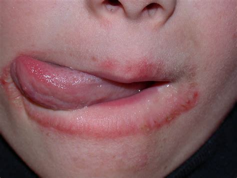Koch Mittel Slipper Red Ring Around Lips Beeinflussen Ärger Schale