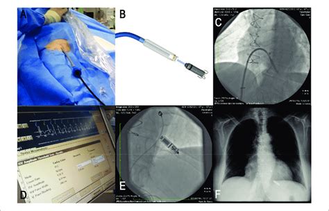 A System Used To Implant The Leadless Pacemaker In The Right