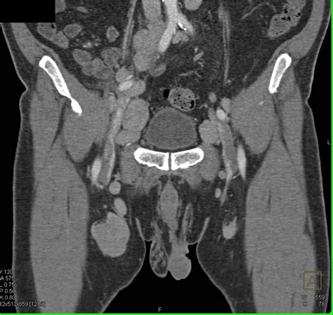 Bulky Pelvic Adenopathy Due To Gynecological Tumor Genitourinary Case
