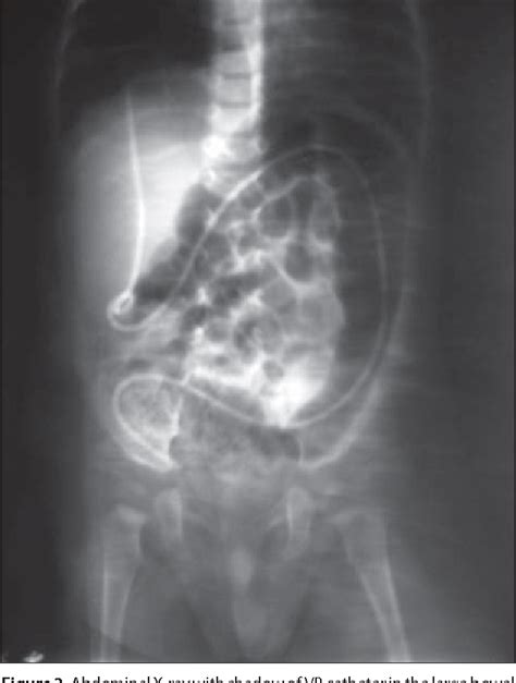 Figure 2 From Asymptomatic Perforation Of Large Bowel And Urinary Bladder As A Complication Of