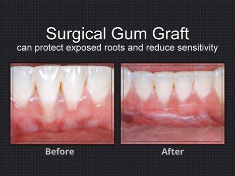 Gum grafting is basically taking the. Surgical gum graft: If your #tooth root has lost gum ...