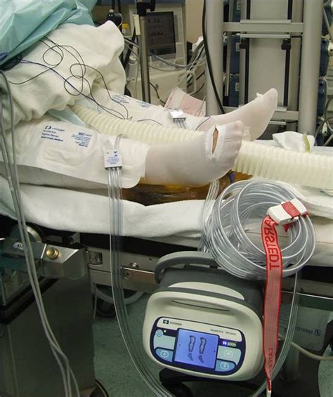 Reduced Risk Of Venous Thromboembolism With The Use Of Intermittent