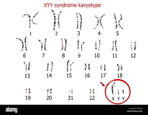 Xyy Syndrom Supermale Karyotyp Stockfotografie Alamy